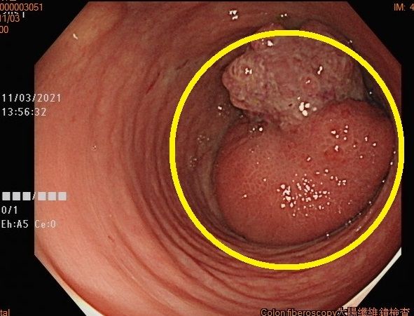 老婦進行大腸鏡檢查發現有腫瘤。烏日林新醫院提供