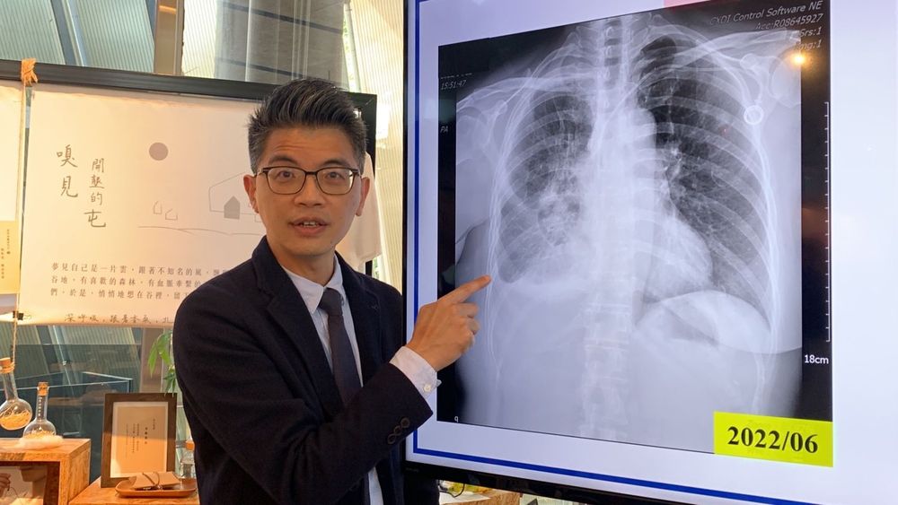 劉良智主任以影像說明林女士乳癌轉移到右肺,導致嚴重肺積水,病況相當嚴重。曾雪蒨攝