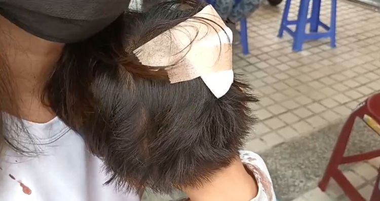 小朋友頭部挫傷，鮮血染紅自己的衣服。讀者提供