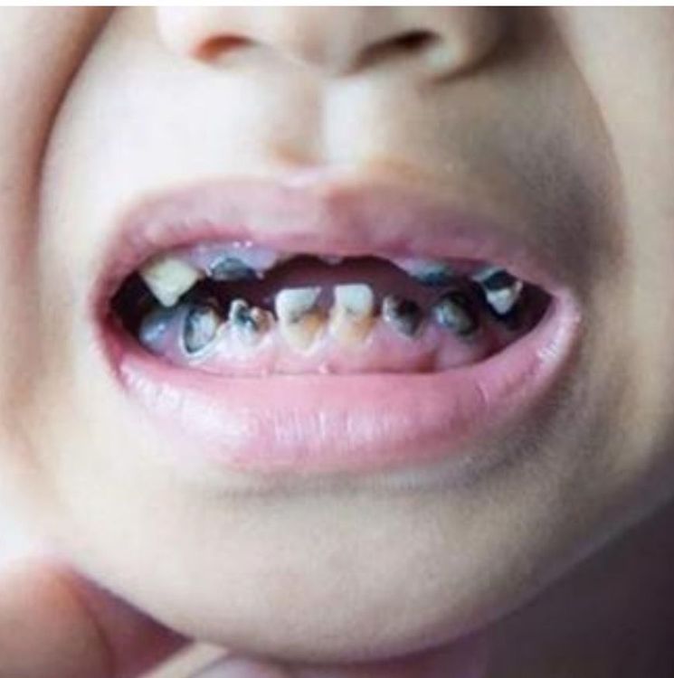 3歲童滿口爛牙。聖保祿醫院提供