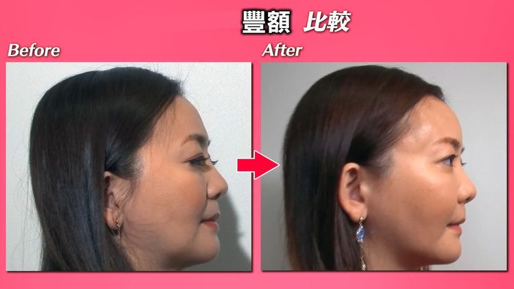 華原朋美注入自體脂肪豐額。翻攝YT