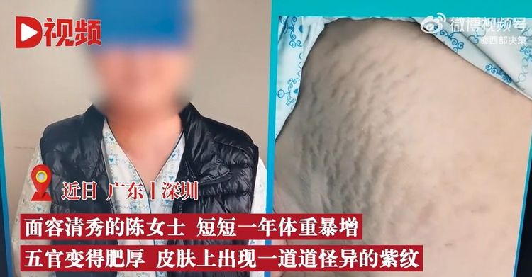 女子皮膚長紫斑。引自微博