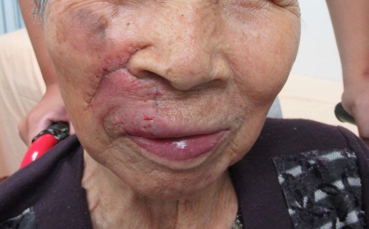 阿嬤切除手術後復原狀況良好，目前還須定期追蹤病況。南投醫院提供