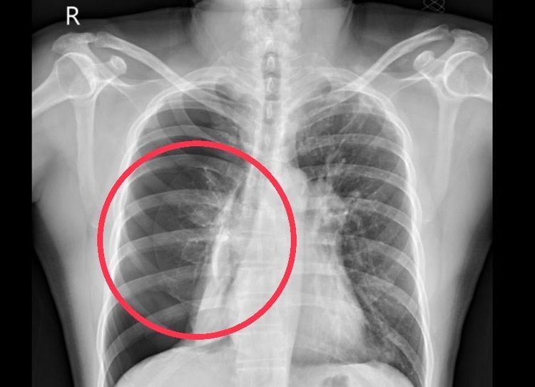 照片X光片的紅圈處為患者右肺明顯塌陷。南投醫院提供