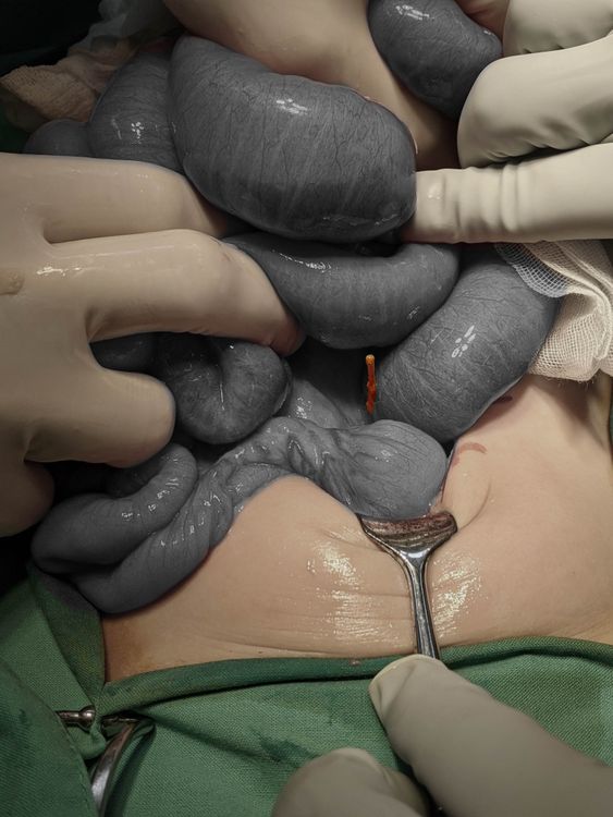 高醫團隊打開女童肚子，赫然看到一根長達8公分的樹枝刺穿女童的十二指腸（經變色處理）。張鈺堂醫師提供