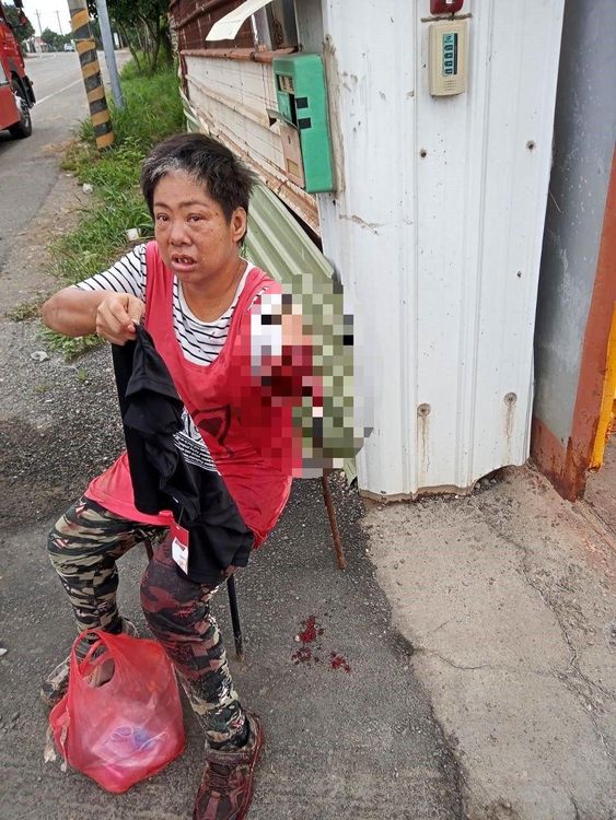 女工遭機器絞斷左手。讀者提供