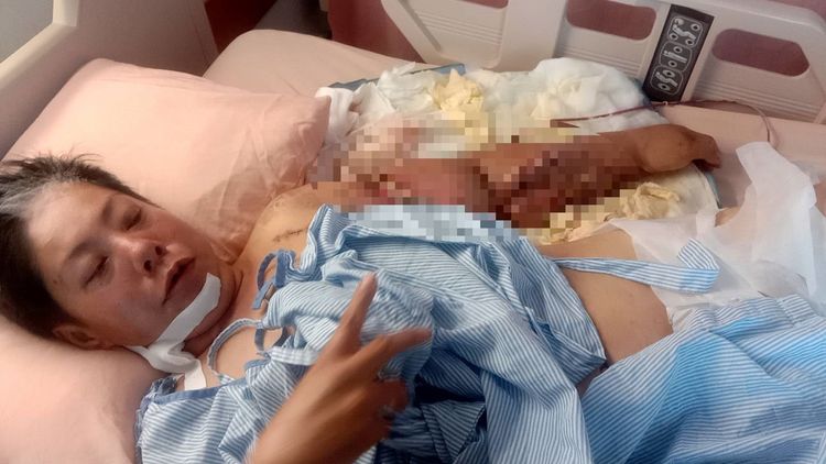 李秀蘭保住斷肢，失能狀況仍待評估。李秀蘭提供