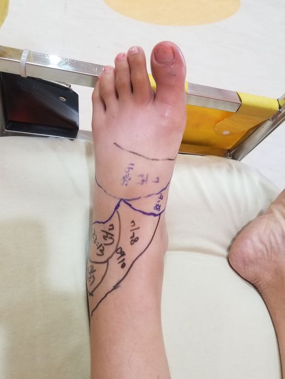 眼鏡蛇蛇吻同時造成傷口周邊皮膚壞死與發炎，治療要花數周到數月，相當麻煩。毛彥喬提供