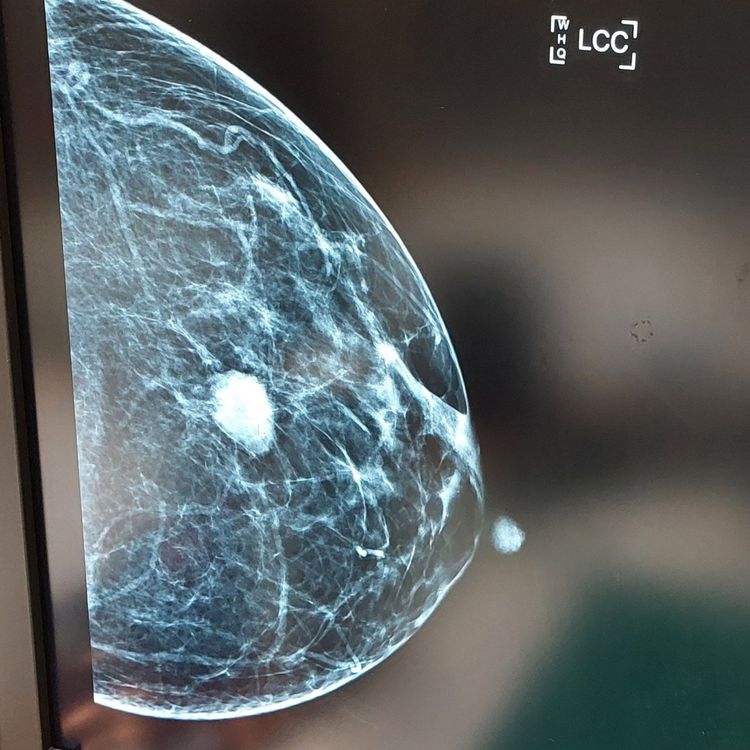 1.86公分的腫瘤，醫師判定為第一期。引自粉絲團《吳少喬，我是女同志，也是媽媽》