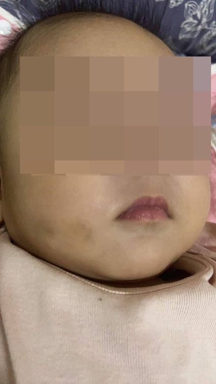 女嬰右側臉頰上的淤青。家屬提供