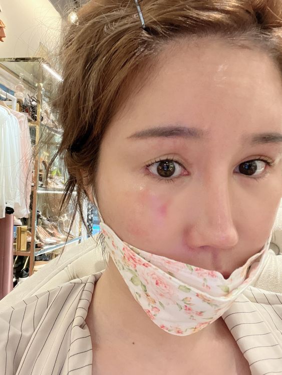 辛尤里臉受傷。翻攝自辛尤里臉書