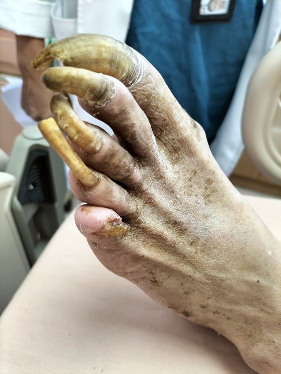 獨居老人的長指甲，背後藏多少故事。翻攝自蘇一峰臉書