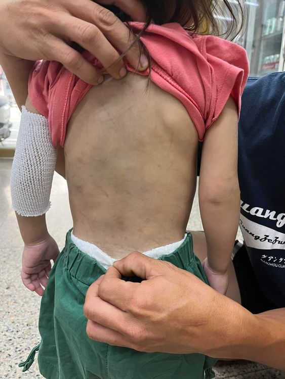 女童背部瘀青。取自藍先生臉書