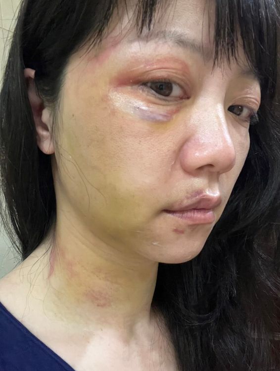 高嘉瑜傷勢慘重。高嘉瑜辦公室提供