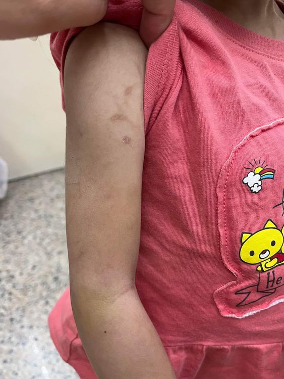 3歲女童身體有多處舊傷。取自藍先生臉書