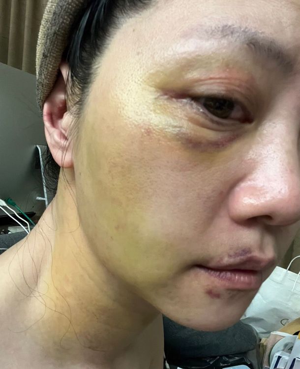 高嘉瑜被林秉樞爆打，傷勢慘重。高嘉瑜辦公室提供