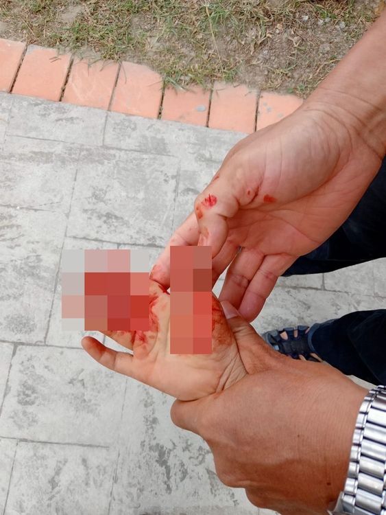 5歲男童滑下溜滑梯，手指被削掉一塊肉。民眾提供