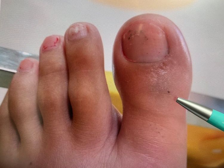 毛彥喬主任用筆指出照服員在廚房遭眼鏡蛇咬傷的傷口。曾雪蒨攝