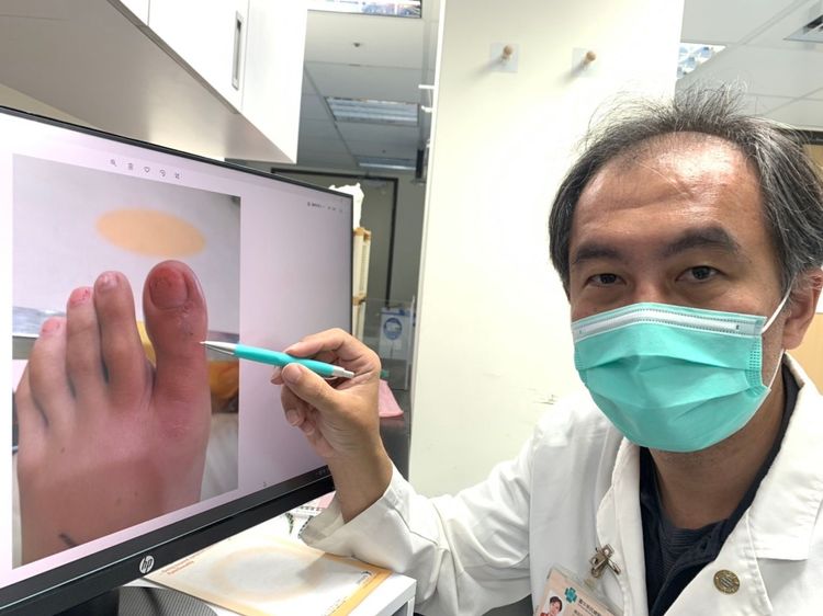 台中榮總毒物科主任毛彥喬說明居服員到獨居左腳趾被眼鏡蛇咬一口！曾雪蒨攝