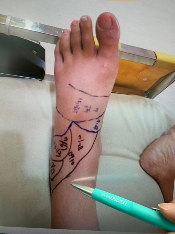 照服員的腳因遭蛇吻腫脹。毛彥喬提供