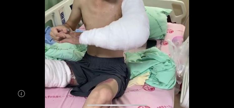 22歲小南斷臂重建手術後恢復良好，現在已經可以練習讓左手臂提高放下的動作，讓醫療團隊相當欣慰。中國附醫提供