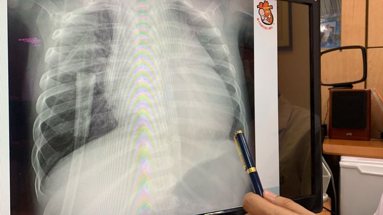 男嬰到院後不到36小時就出現猛爆性心肌炎，心臟擴大呈現心衰竭症狀。曾雪蒨攝