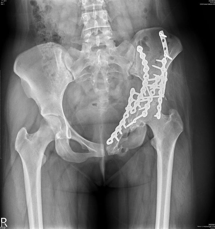 女大生的左側骨盆粉碎性骨折接受骨折復位固定手術，X光片呈現的是密密麻麻的鋼板和鋼釘。左側的股骨頭有創傷後骨壞死的情況發生。大里仁愛醫院提供