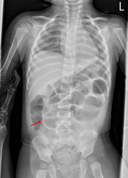 在X光片中，可看到女童因腸穿孔、腹腔內充斥不該有的空氣，造成腸壁在影像中異常明顯（如箭頭）。張鈺堂醫師提供