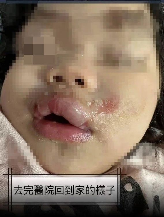 高雄一名1歲女童在托嬰中心疑遭不當照顧，嘴部有二度燙傷。翻攝自臉書報廢公社