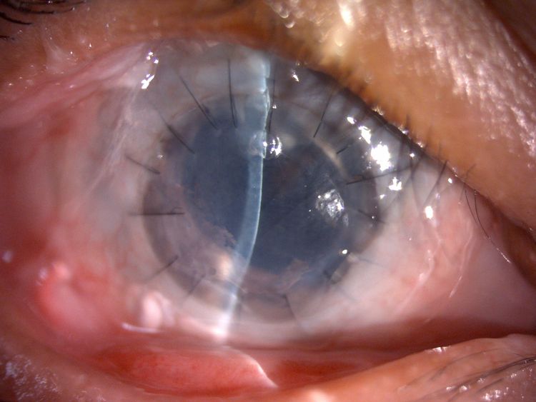 角膜移植に伴うリスクは何ですか?