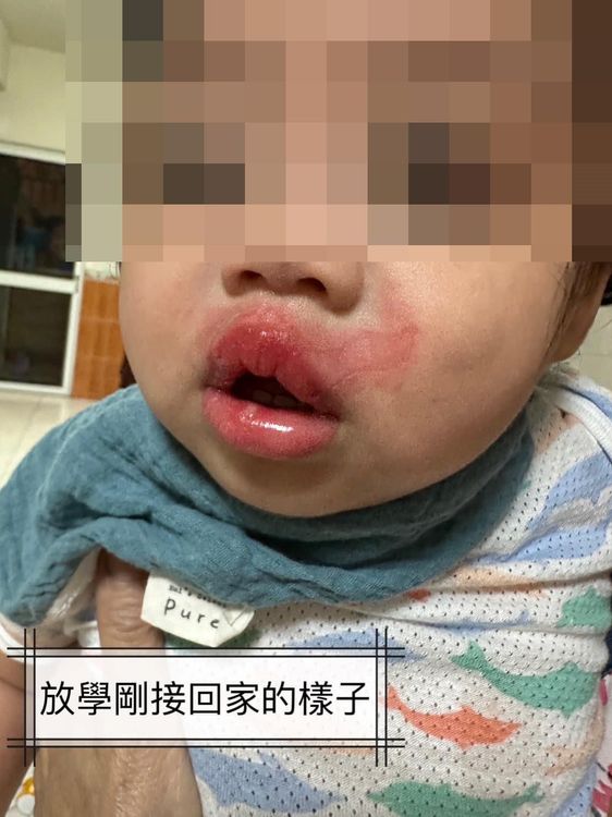 高雄一名1歲女童在托嬰中心疑遭不當照顧，嘴部有二度燙傷。翻攝自臉書爆料公社