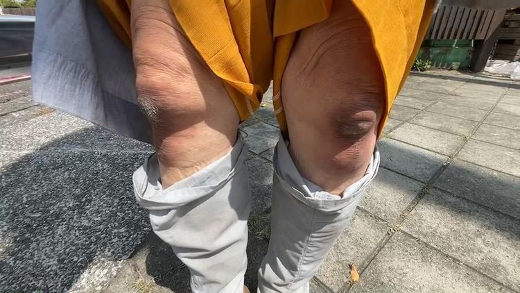 紅腫瘀青的兩膝。民眾提供