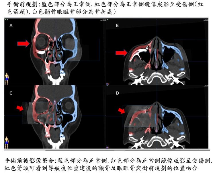 手術前後顱內影像。大里仁愛醫院提供