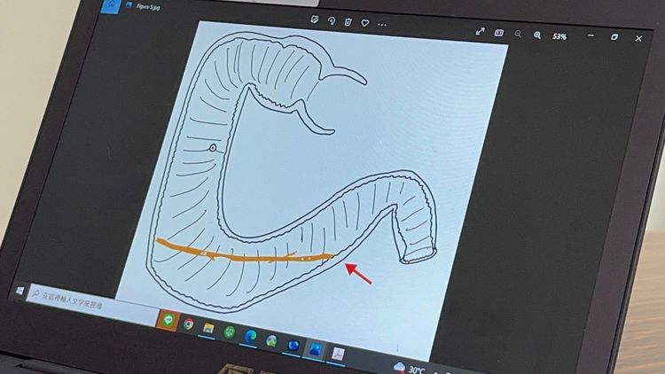 張鈺堂主任研判樹枝卡進女童十二指腸後，撐著腸壁、最後穿腸而出，造成腹膜炎。侯昌騰翻攝
