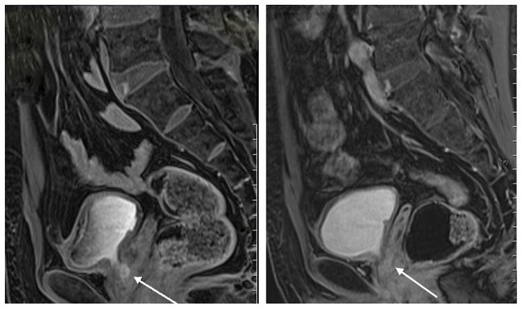老醫師因頻尿、解不乾淨發現攝護腺癌（左），經過37次光子刀放射線治療讓腫瘤消失 （右）。中港澄清醫院提供