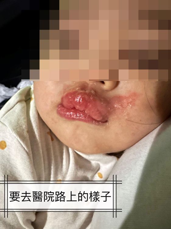 高雄一名1歲女童在托嬰中心疑遭不當照顧，嘴部有二度燙傷。翻攝自臉書爆料公社