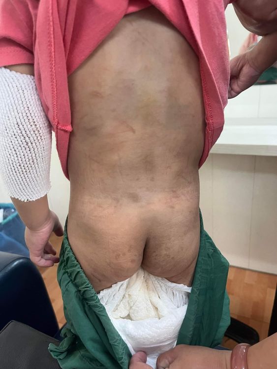 明顯可見女童滿身瘀青。取自藍先生臉書