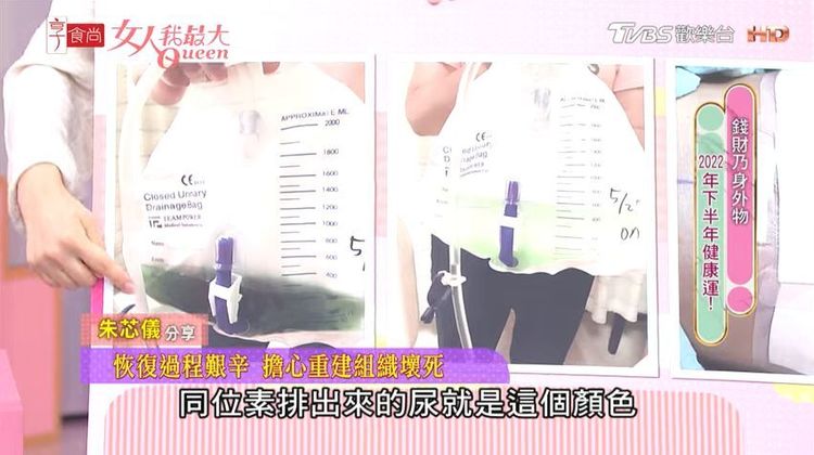 朱芯儀手術前打了同位素，排出的尿液為深綠色（左），2、3天後顏色才變淡。翻攝女人我最大YouTube
