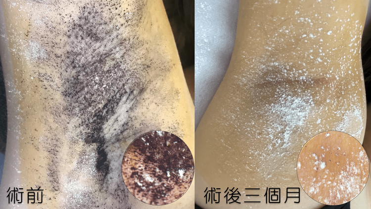 碘澱粉測試可評估出汗狀況，汗液與優碘澱粉產生化學反應後，呈藍黑色，患者經治療後腋下出汗程度有明顯改善。大里仁愛醫院提供