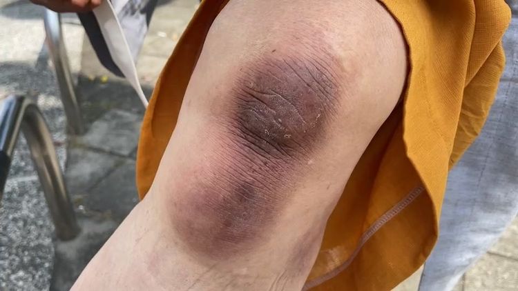 長年跪行拖磨出的膝蓋。民眾提供