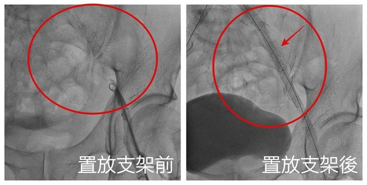 醫療團隊置放支架打通阻塞的髂動脈血管。亞大醫院提供