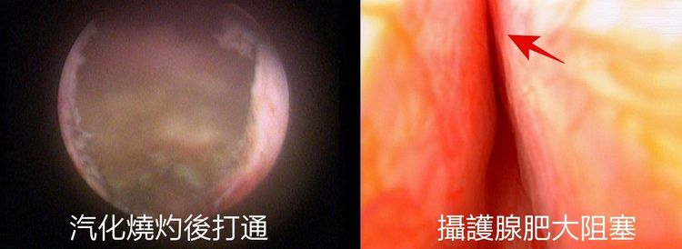 醫師透過手術將肥大攝護腺燒灼打通，徹底解決頻尿問題。亞大醫院提供