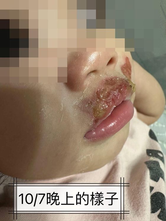 高雄一名1歲女童在托嬰中心疑遭不當照顧，嘴部有二度燙傷。翻攝自臉書爆料公社