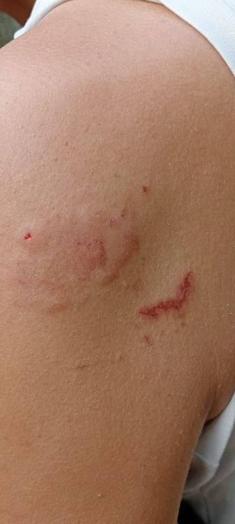 網友PO出與獼猴奮戰兩分鐘後，手背遭猴子遭咬傷照。翻攝自臉書高雄柴山樂遊交流