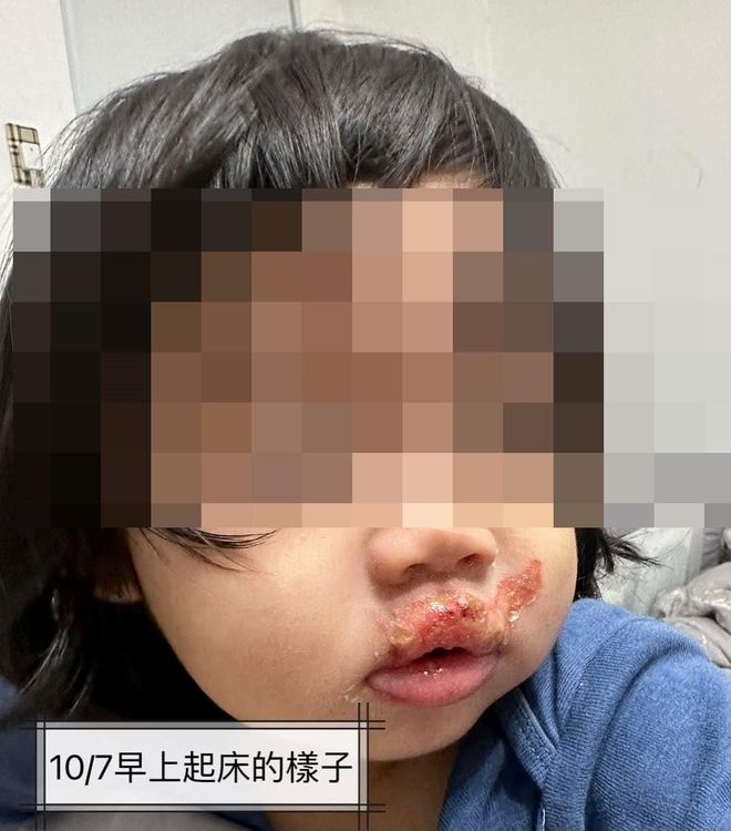 高雄一名1歲女童在托嬰中心疑遭不當照顧，嘴部有二度燙傷。翻攝自臉書爆料公社