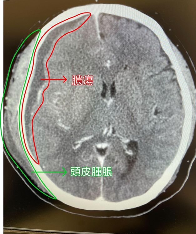 該名工程師病程進展快速，引發敗血性休克，顱內膿瘍、呼吸衰竭。中醫大提供