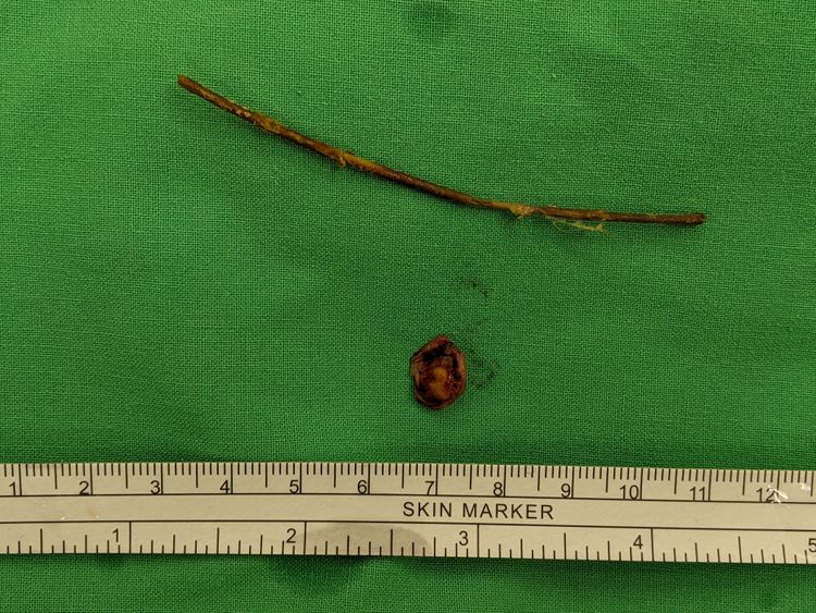 高醫團隊開刀取出女童體內長達8公分樹枝，下方圓點為女童受損的部分腸組織。張鈺堂醫師提供