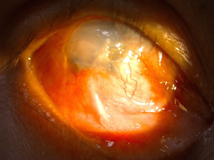 阮手術前男遭強酸灼傷的右眼。亞東醫院提供