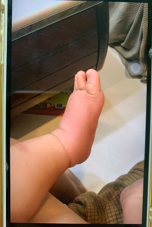 金黃葡萄球菌感染釀成蜂窩性組織炎。門諾醫院提供