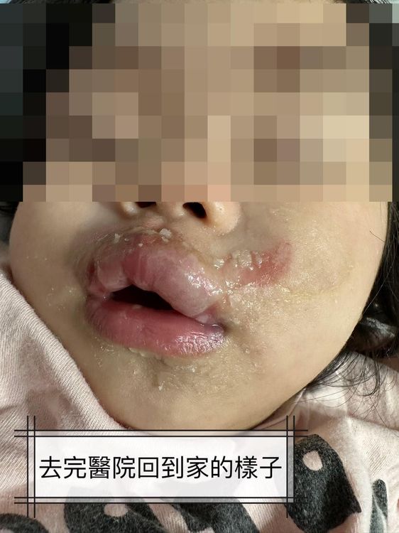 高雄一名1歲女童在托嬰中心疑遭不當照顧，嘴部有二度燙傷。翻攝自臉書爆料公社